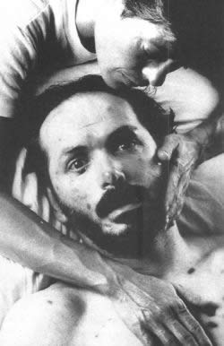 世界公布首例爱滋病(TodayOnHistory.COM)